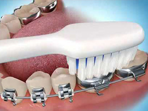 Bracket Care (braces care)