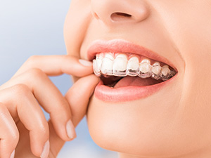 Invisalign or clear aligner treatment for teeth correction