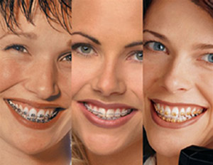 How Old Is Too Old For Braces?
