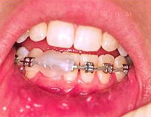 Emergencies in Orthodontics
