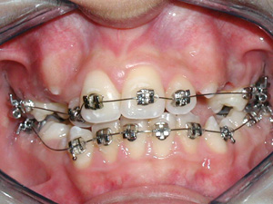 What Causes Orthodontic Disorder?
