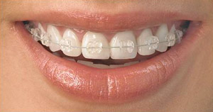 Orthodontic treatment cost