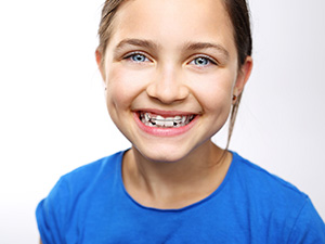 What Is the Best Age to Start Orthodontic Treatment?