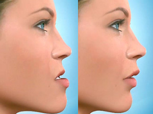 What Is Orthognathic Surgery?