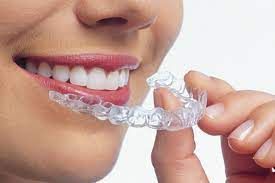 Things to Consider in Clear Aligner Treatment